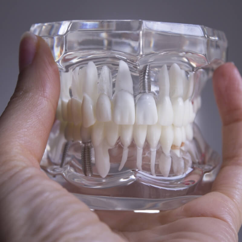 Removable dentures